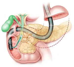 Endoscopy procedure