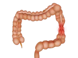 Gastroenterology: IBS